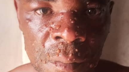 Kasaï : 3 cas suspects de Mpox signalés à Luebo, dont un décès